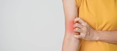 Kaşınan ve kaşınan bir kadın. Böcek ısırığına karşı hassas deri alerjisi, yemek, uyuşturucu dermatiti. Dermatoloji, cüzzam günü, sistemik lupus eritematoz, alerji semptomları ve isilik.