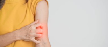 Kaşınan ve kaşınan bir kadın. Böcek ısırığına karşı hassas deri alerjisi, yemek, uyuşturucu dermatiti. Dermatoloji, cüzzam günü, sistemik lupus eritematoz, alerji semptomları ve isilik.