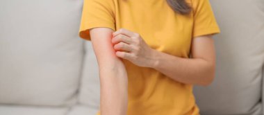 Kaşınan ve kaşınan bir kadın. Böcek ısırığına karşı hassas deri alerjisi, yemek, uyuşturucu dermatiti. Dermatoloji, cüzzam günü, sistemik lupus eritematoz, alerji semptomları ve isilik.