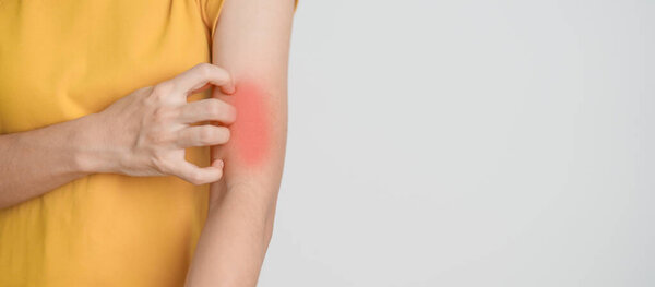 woman itching and scratching itchy arm. Sensitive Skin Allergic reaction to insect bite, food, drug dermatitis. Dermatology, Leprosy day, Systemic lupus erythematosus, Allergy symptoms and rash Eczema