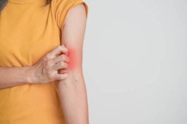 Kaşınan ve kaşınan bir kadın. Böcek ısırığına karşı hassas deri alerjisi, yemek, uyuşturucu dermatiti. Dermatoloji, cüzzam günü, sistemik lupus eritematoz, alerji semptomları ve isilik.