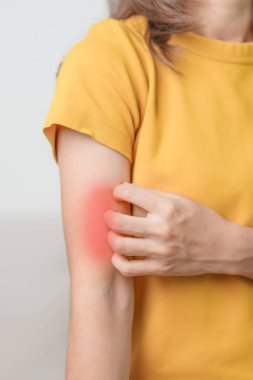 Kaşınan ve kaşınan bir kadın. Böcek ısırığına karşı hassas deri alerjisi, yemek, uyuşturucu dermatiti. Dermatoloji, cüzzam günü, sistemik lupus eritematoz, alerji semptomları ve isilik.