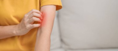 Kaşınan ve kaşınan bir kadın. Böcek ısırığına karşı hassas deri alerjisi, yemek, uyuşturucu dermatiti. Dermatoloji, cüzzam günü, sistemik lupus eritematoz, alerji semptomları ve isilik.