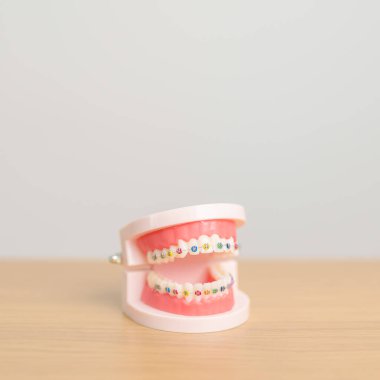 Ortodontik diş modeli ve parantez ya da destek. Tartarı temizleyin ve kazıyın. Mayıs Ortodonti Sağlık Günü, Mart Sağlığı, Diş Hekimleri Günü, Takma Diş. Diş Ağrısı ve Çocuk Diş Sağlığı