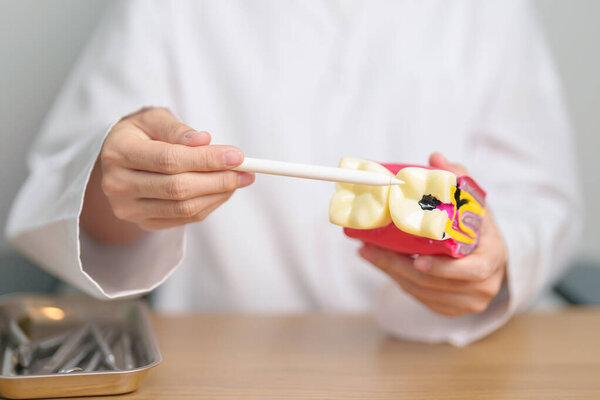 Dentist with tooth Anatomy model. Oral Teeth decay and disease, Scrape off tartar. March Oral health, Dentist Day, False Teeth. Toothache and Children Dental Health Month and Orthodontic Health Day