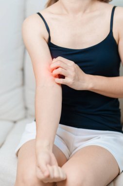 Kaşınan ve kaşınan bir kadın. Böcek ısırığına karşı hassas deri alerjisi, yemek, uyuşturucu dermatiti. Dermatoloji, cüzzam günü, sistemik lupus eritematoz, alerji semptomları ve isilik.