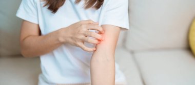 Kaşınan ve kaşınan bir kadın. Böcek ısırığına karşı hassas deri alerjisi, yemek, uyuşturucu dermatiti. Dermatoloji, cüzzam günü, sistemik lupus eritematoz, alerji semptomları ve isilik.