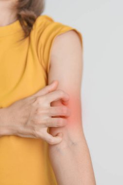 Kaşınan ve kaşınan bir kadın. Böcek ısırığına karşı hassas deri alerjisi, yemek, uyuşturucu dermatiti. Dermatoloji, cüzzam günü, sistemik lupus eritematoz, alerji semptomları ve isilik.