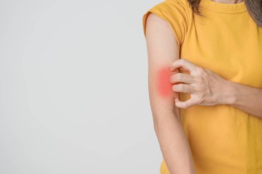 Kaşınan ve kaşınan bir kadın. Böcek ısırığına karşı hassas deri alerjisi, yemek, uyuşturucu dermatiti. Dermatoloji, cüzzam günü, sistemik lupus eritematoz, alerji semptomları ve isilik.