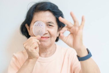 Göz ameliyatından sonra koruyucu kalkanı olan yaşlı bir kadın. Göz hastalığı, Katarakt, Glaukoma, Yaşla İlgili Maküler Dejenerasyon, Diyabetik Retinopati, Vitreous, Lasik, Dünya Glaukoma Günü ve Sağlık 