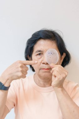 Göz ameliyatından sonra koruyucu kalkanı olan yaşlı bir kadın. Göz hastalığı, Katarakt, Glaukoma, Yaşla İlgili Maküler Dejenerasyon, Diyabetik Retinopati, Vitreous, Lasik, Dünya Glaukoma Günü ve Sağlık 