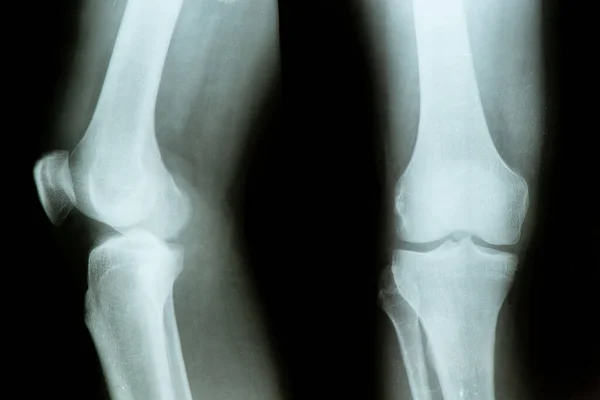 X-ray of a patient with a torn meniscus of the knee joint in a man and diagnosis