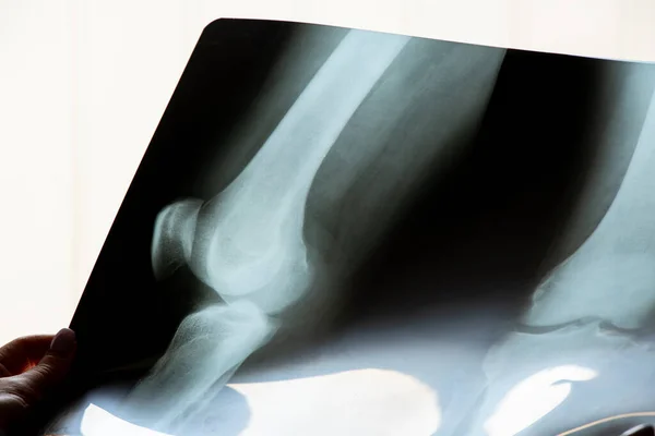 病人膝关节半月板撕裂的X线表现及诊断 — 图库照片