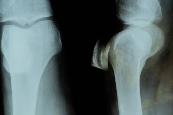 病人膝关节半月板撕裂的X线表现及诊断 — 图库照片