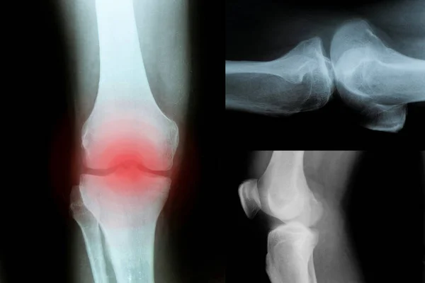 X-ray of a patient with a torn meniscus of the knee joint in a man and diagnosis, three x-rays with a knee