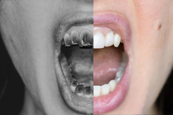 Відкритий Рот Дівчини Запаленою Сигаретою Замість Зубів Прикладом Після Куріння — стокове фото