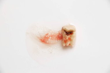 Diş bakımı, diş çekilmesi, diş cerrahisi, diş bakımı, diş bakımı gibi dişleri söktükten sonra tükürük ve kanla kaplı beyaz bir arkaplanda bulunan diş bakımı tarafından tahrip edilmiş bir diş.