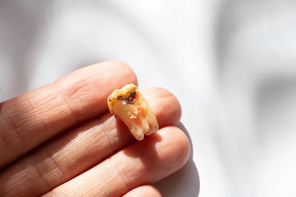 A girl in her hand holds an extracted tooth with a black hole in the middle of the tooth, close-up on a table, in her hand she holds a sick tooth after removal, which cannot be restored, dentistry