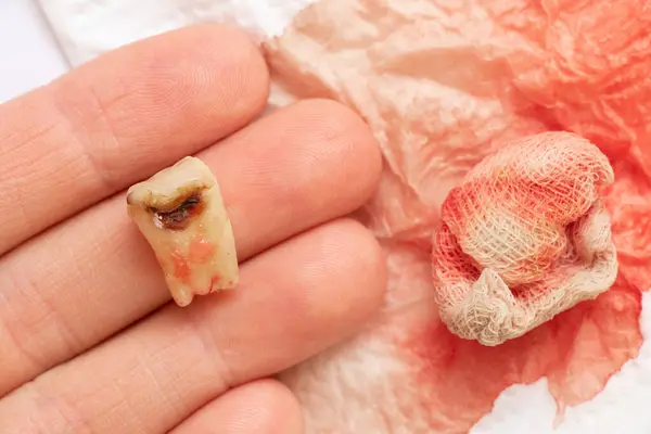 A girl in her hand holds an extracted tooth with a black hole in the middle of the tooth, close-up against the background of a bandage with blood, in her hand she holds a sore tooth after removal, which cannot be restored, dentistry