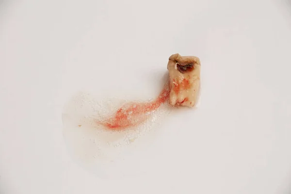 Extracted Tooth Destroyed Caries Hole Middle Lies White Background Saliva — Stock Photo, Image