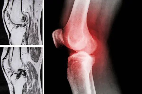 Magnetic resonance imaging and x-ray of the knee after removal of the meniscus and restoration of the cruciate ligament, knee