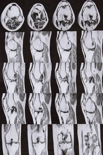 Magnetic resonance imaging of the knee joint after removal of the meniscus and reconstruction of the cruciate ligament of the knee joint, knee after surgery