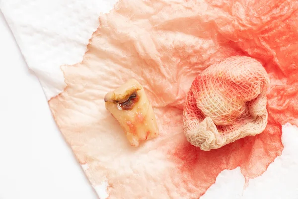 An extracted tooth with a black hole in the middle of the tooth, close-up against the background of a bandage with blood, a sick tooth after extraction that cannot be restored, dentistry