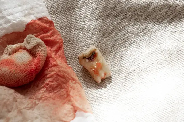 An extracted tooth with a black hole in the middle of the tooth, close-up against the background of a bandage with blood, a sick tooth after extraction that cannot be restored, dentistry