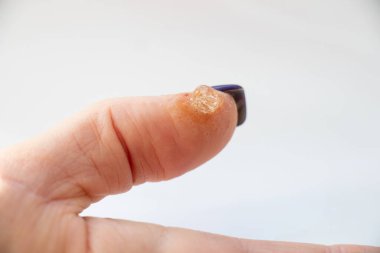 Alerjik reaksiyon ve parmak kızarıklığı ve tedavi için sürtünmüş jel, cilt tahrişi, kuru cilt yakın çekim