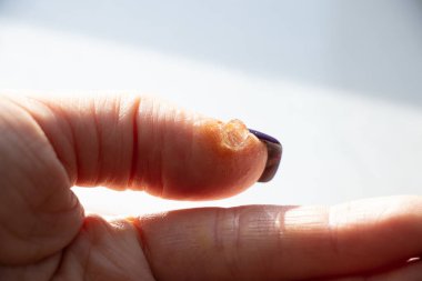 Alerjik reaksiyon ve parmak kızarıklığı ve tedavi için sürtünmüş jel, cilt tahrişi, kuru cilt yakın çekim