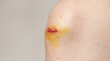 Düşme, kaza ve yaralanmadan sonra kızın dizindeki kanla yakın çekim.