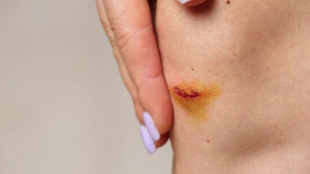 怪我の後 少女の膝に血が付いた傷のクローズアップ — ストック動画