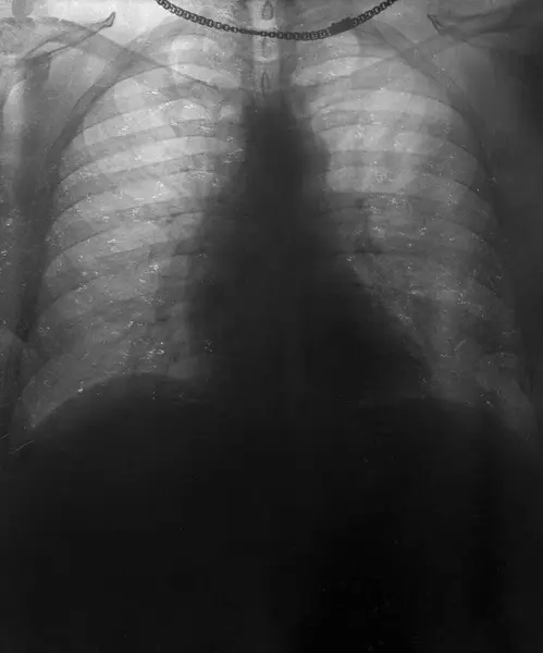 stock image Chest X-ray of a man having a heart attack, heart attack and diagnosis