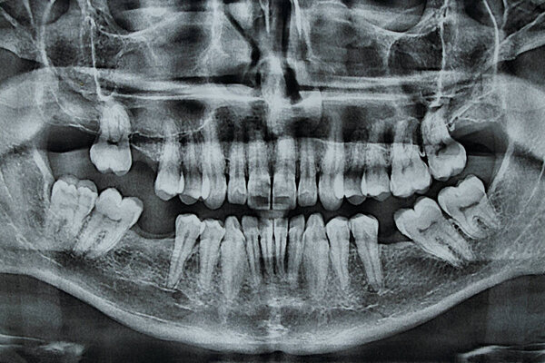 Panoramic dental x-ray for acute pain from wisdom tooth and broken nose, dentistry and diagnostics
