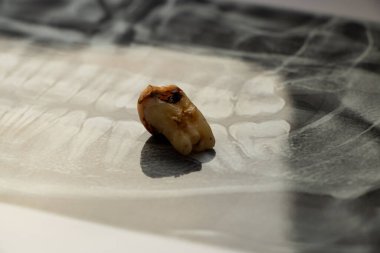 Erkek dişlerinin, diş hekimliğinin, diş tedavisinin panoramik görüntüsünde bir delikli yirmilik dişi var.