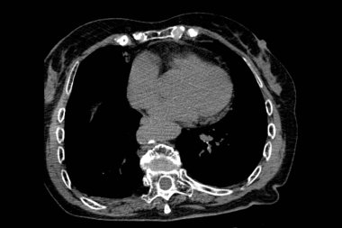 Th9-Th12 omurunda osteoporoz ve sıkıştırma kırıkları olan bir büyükannenin tomografisi ve ayrıca omurlarda L1-L2 omurunda deformasyon ve skleroz var.
