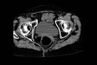 Th9-Th12 omurunda osteoporoz ve sıkıştırma kırıkları olan bir büyükannenin tomografisi ve ayrıca omurlarda L1-L2 omurunda deformasyon ve skleroz var.