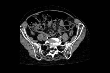Th9-Th12 omurunda osteoporoz ve sıkıştırma kırıkları olan bir büyükannenin tomografisi ve ayrıca omurlarda L1-L2 omurunda deformasyon ve skleroz var.
