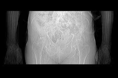 Th9-Th12 omurunda osteoporoz ve sıkıştırma kırıkları olan bir büyükannenin tomografisi ve ayrıca omurlarda L1-L2 omurunda deformasyon ve skleroz var.
