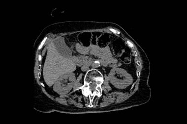 Th9-Th12 omurunda osteoporoz ve sıkıştırma kırıkları olan bir büyükannenin tomografisi ve ayrıca omurlarda L1-L2 omurunda deformasyon ve skleroz var.