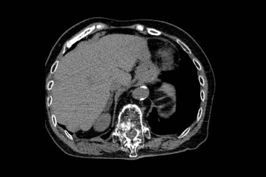 Th9-Th12 omurunda osteoporoz ve sıkıştırma kırıkları olan bir büyükannenin tomografisi ve ayrıca omurlarda L1-L2 omurunda deformasyon ve skleroz var.