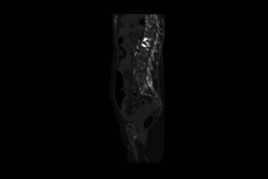 Th9-Th12 omurunda osteoporoz ve sıkıştırma kırıkları olan bir büyükannenin tomografisi ve ayrıca omurlarda L1-L2 omurunda deformasyon ve skleroz var.