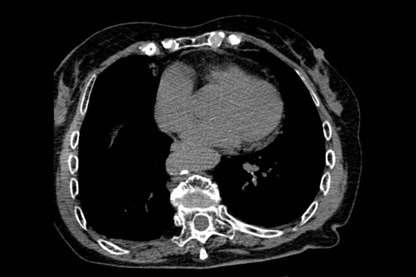 Вычислительная томография бабушки после падения с остеопорозом и компрессионными переломами позвонков Th9-Th12, а также операция по деформации позвонков L1-L2 позвонков и склероза эндплит