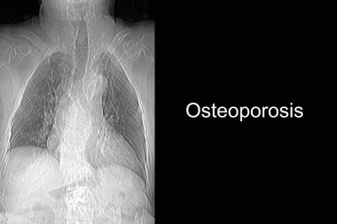 Th9-Th12 omurunda osteoporoz ve sıkıştırma kırıkları olan bir büyükannenin tomografisi ve omurdaki L1-L2 deformasyonu.