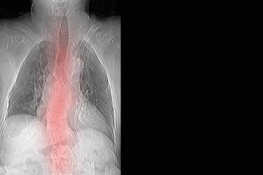 Th9-Th12 omurunda osteoporoz ve sıkıştırma kırıkları olan bir büyükannenin tomografisi ve omurdaki L1-L2 deformasyonu.