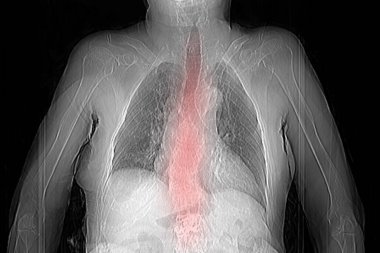 Th9-Th12 omurunda osteoporoz ve sıkıştırma kırıkları olan bir büyükannenin tomografisi ve omurdaki L1-L2 deformasyonu.