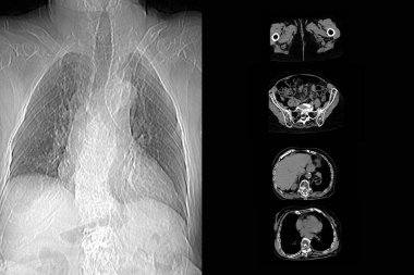 Th9-Th12 omurunda osteoporoz ve sıkıştırma kırıkları olan bir büyükannenin tomografisi ve omurdaki L1-L2 deformasyonu.