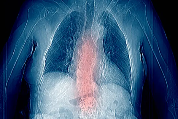 Th9-Th12 omurunda osteoporoz ve sıkıştırma kırıkları olan bir büyükannenin tomografisi ve omurdaki L1-L2 deformasyonu.