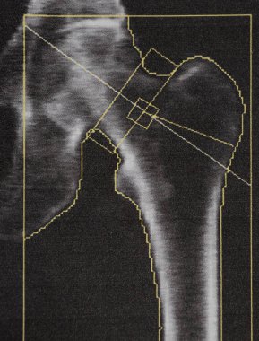 Ciddi osteoporoz geçiren yaşlı bir kadının uyluk kemiğinde kemik yoğunluğu teşhisi, osteoporoz tespiti için tıbbi muayene.