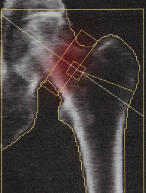 Ciddi osteoporoz geçiren yaşlı bir kadının uyluk kemiğinde kemik yoğunluğu teşhisi, osteoporoz tespiti için tıbbi muayene.